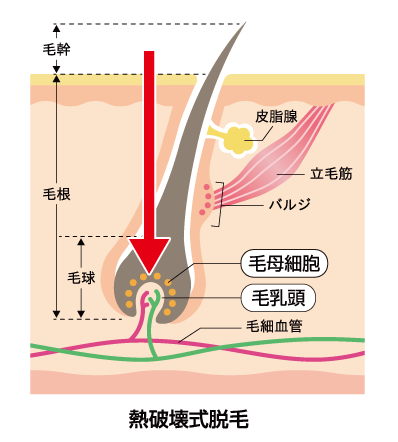 熱破壊式脱毛