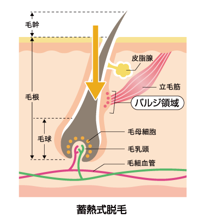 蓄熱式脱毛