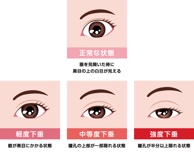 眼瞼下垂の重要度