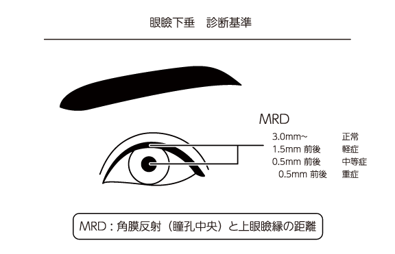 眼瞼下垂 診断基準