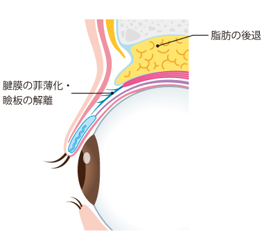 眼瞼下垂の主な原因