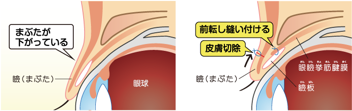 挙筋前転法